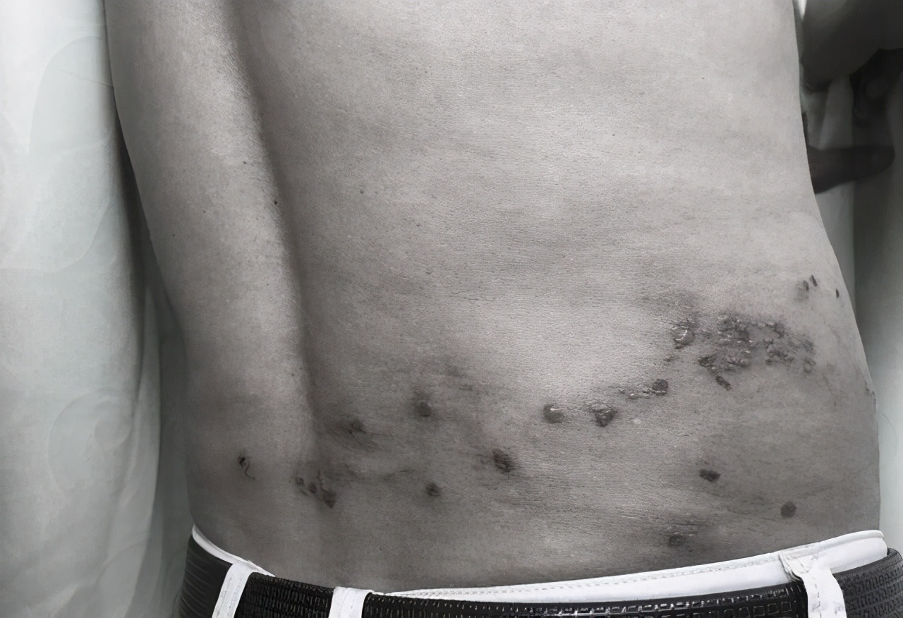 缠腰蛇带状疱疹专用药,蛇缠腰带状疱疹最佳治疗方法