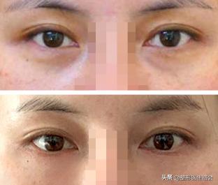 淡化泪沟有什么小技巧和方法,泪沟越来越明显是什么原因