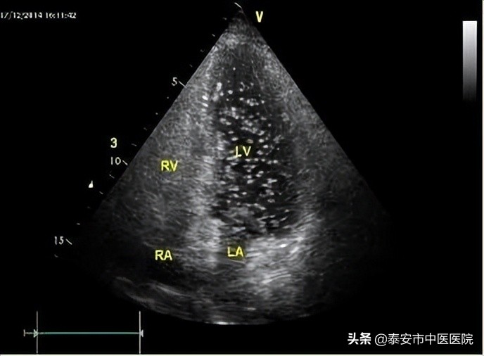 无症状核磁共振诊断脑梗,不明原因头疼需要做脑血管造影吗