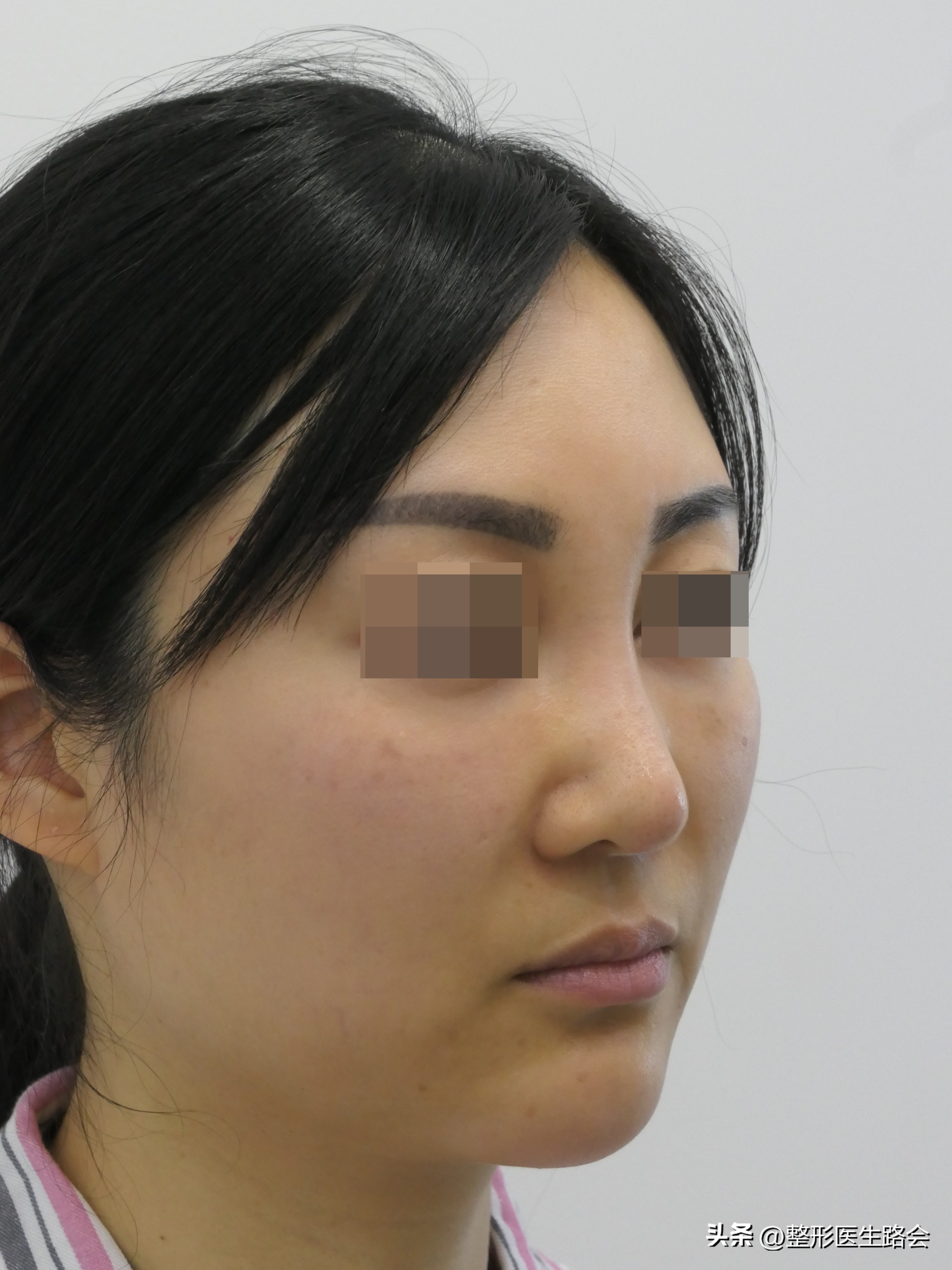 做鼻基底填充消除法令纹有风险吗,鼻基底填充能消除法令纹吗