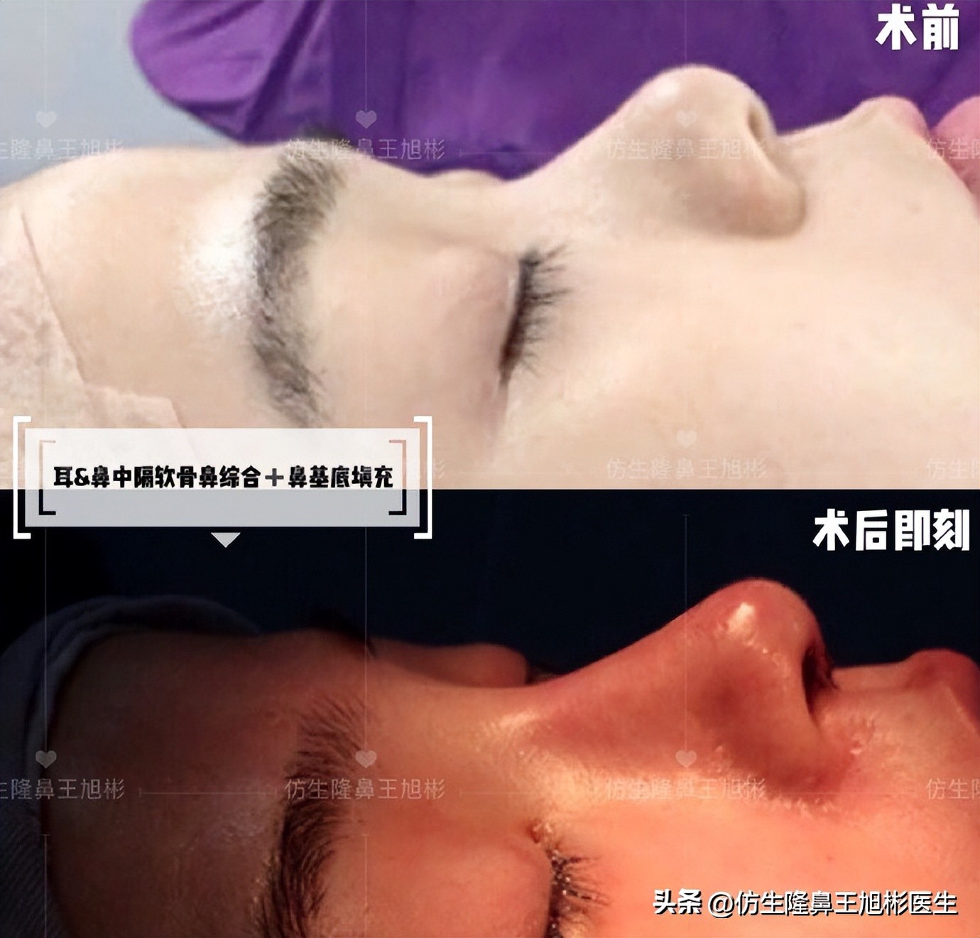 整形鼻部科普知识,隆鼻整形科普知识