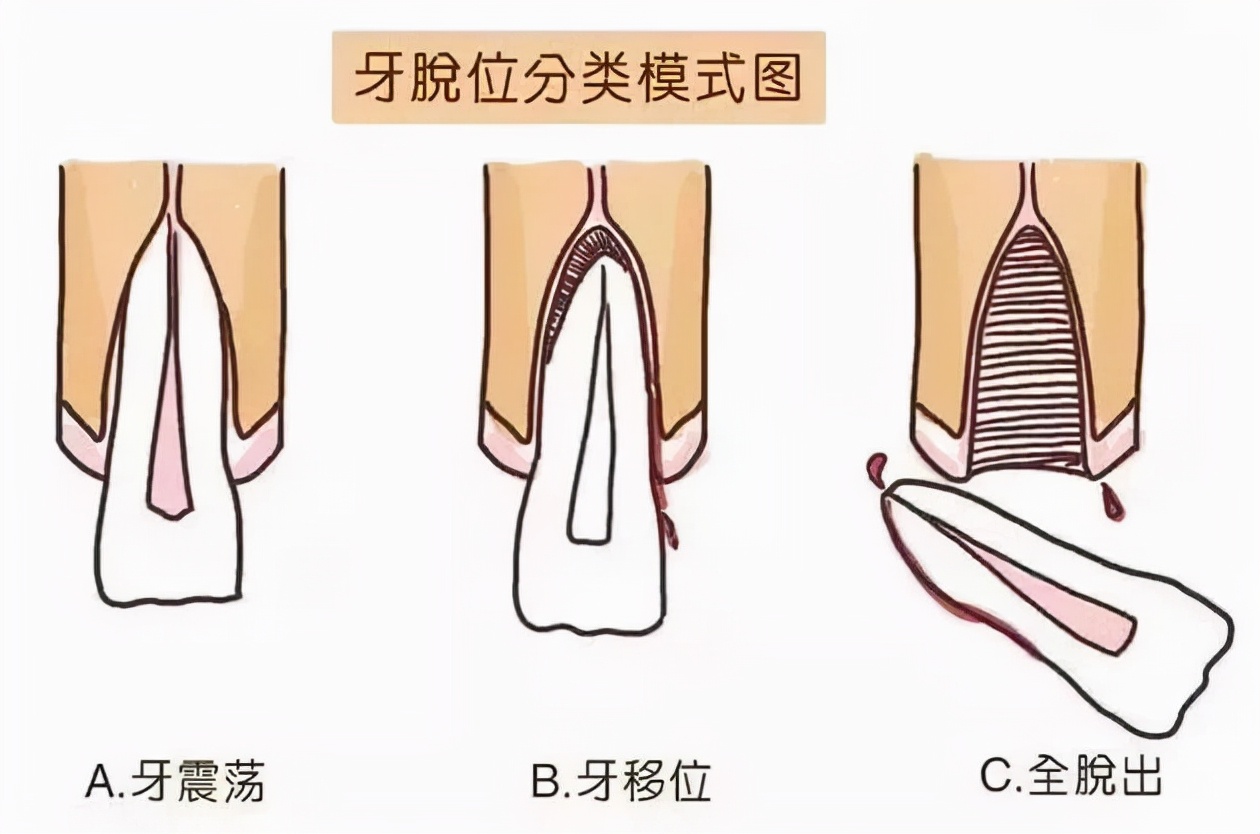 小孩门牙磕断了一个角,十岁孩子磕断门牙怎么办