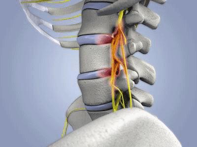 中医治疗椎间盘突出怎么治疗,温通针法治疗椎间盘突出