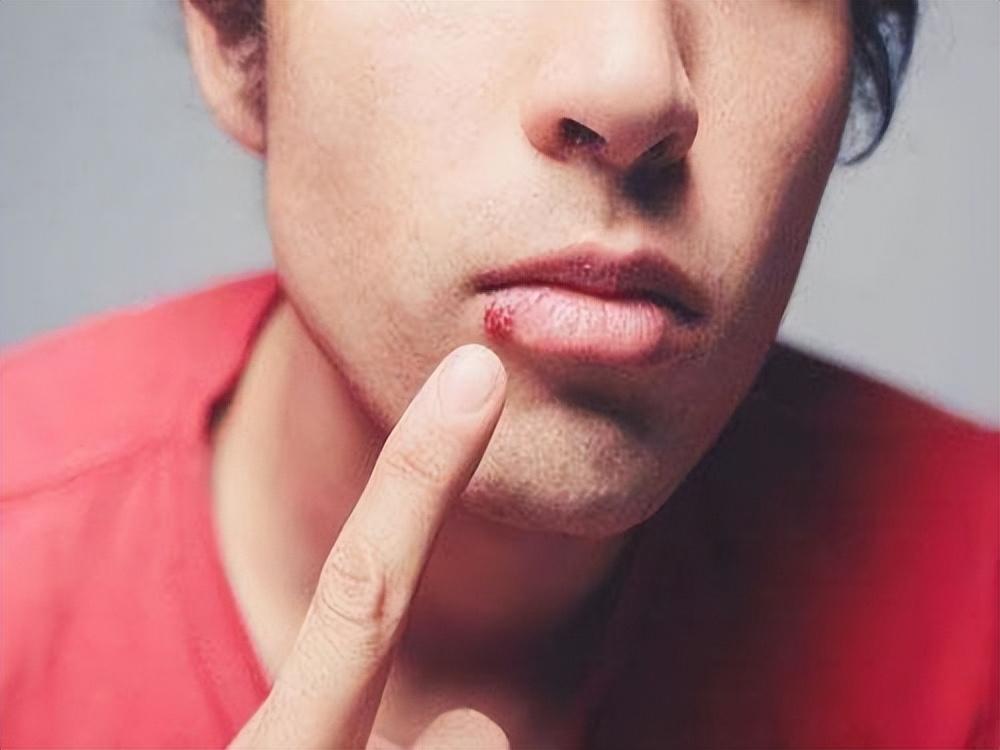 烂嘴角是怎么回事是上火吗,烂嘴角到底是什么病