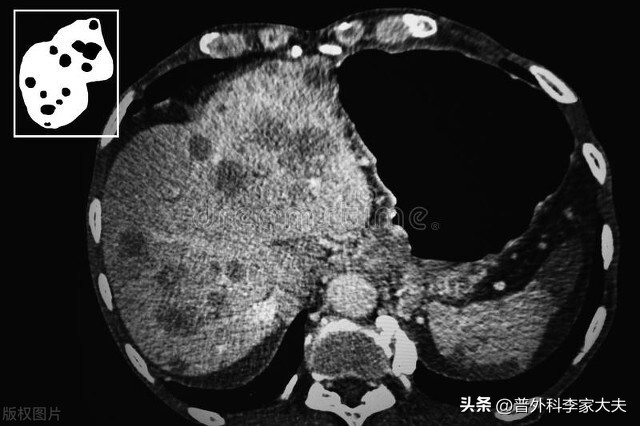 肝癌靶向治疗方法大全,肝癌的靶向治疗