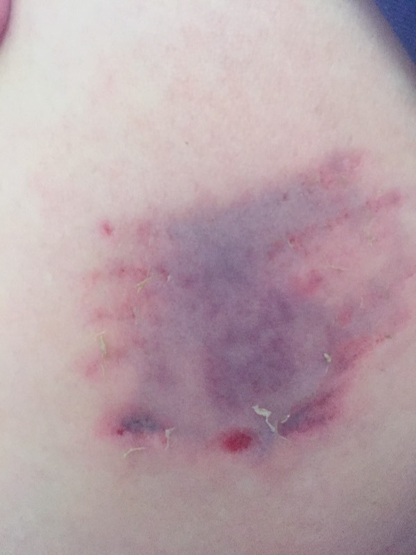 体内有淤血吃什么调理得又快又好,如何活血化瘀祛身体的淤血