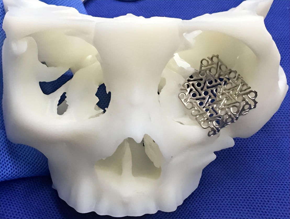 眼眶骨折怎么治疗,眼眶骨折算几级轻伤