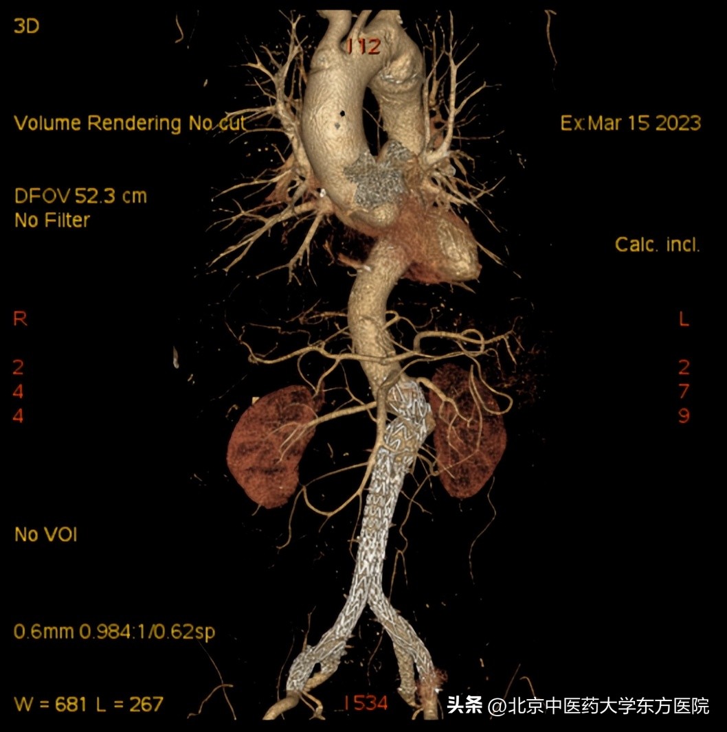 北京中医药大学东方医院成功完成首例保留双侧髂内动脉的巨大腹主动脉瘤合并双侧髂动脉瘤腔内隔绝术！