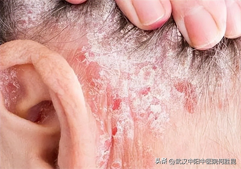 小腿上有癣发痒脱皮流水,眉头长癣干燥脱皮还痒擦什么药