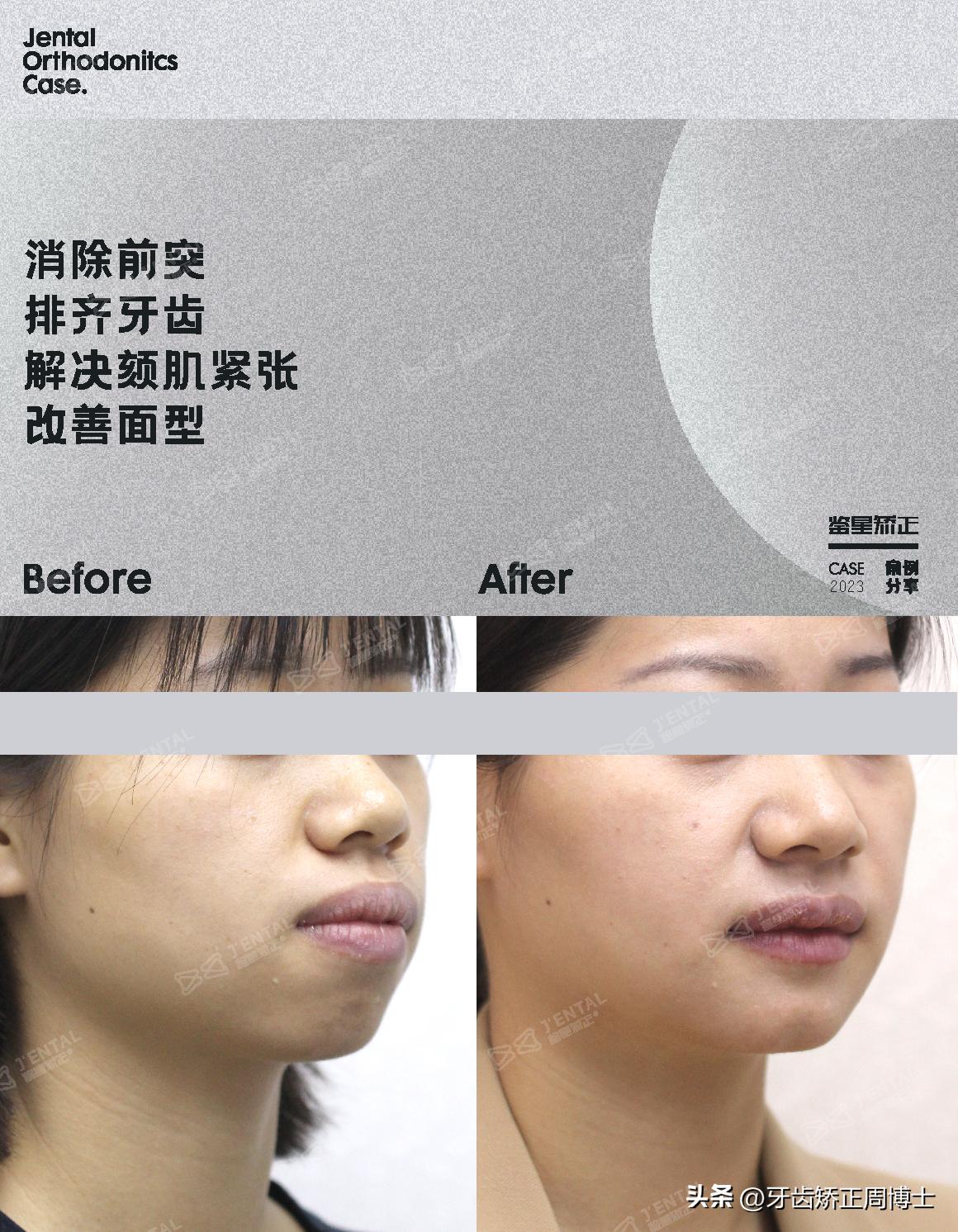 骨性上颌前凸嘴怎么矫正,厚嘴唇与嘴凸有关吗