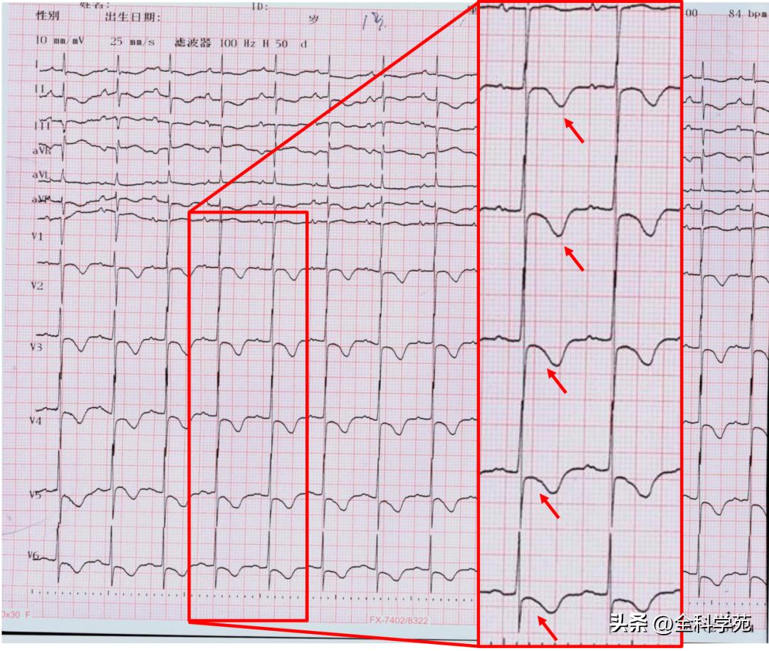 t波倒置三种常见原因,t波低平倒置有事吗