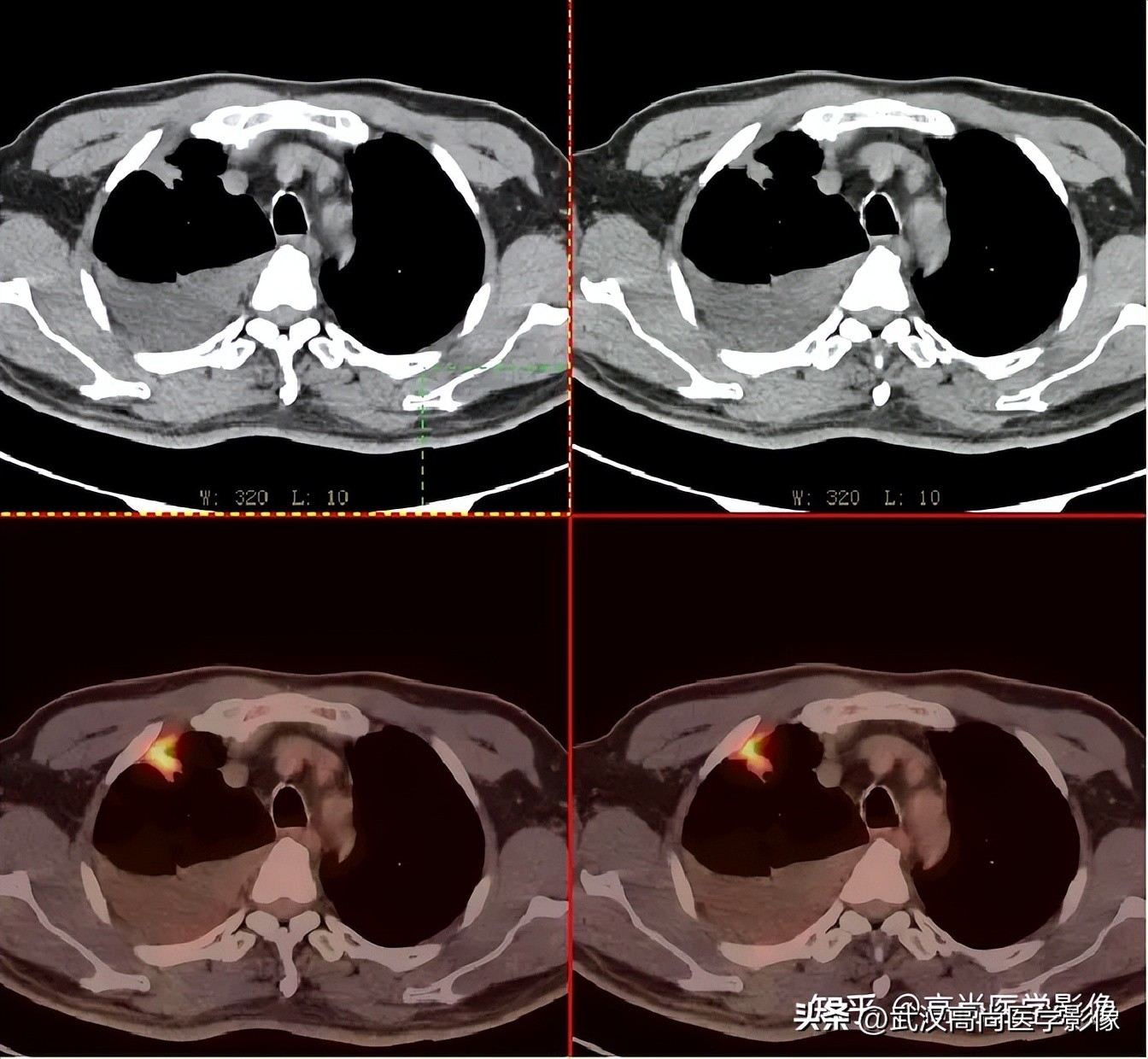 10毫米的肺结节恶性死亡率有多大,1厘米多的肺结节良性可能性多大