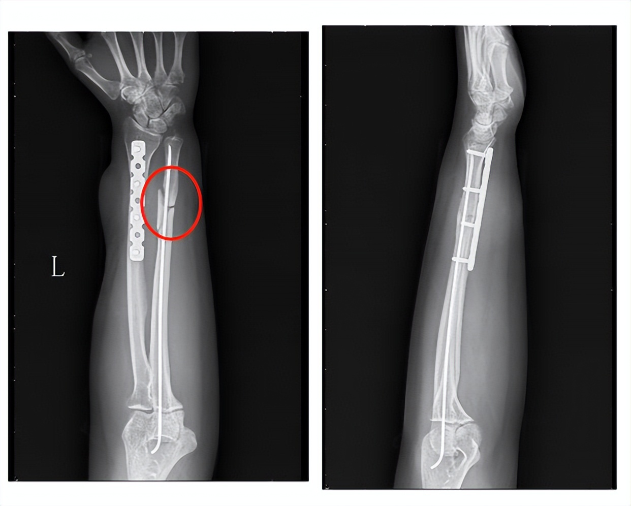 治疗骨折新技术,微创手术治疗骨折的方法