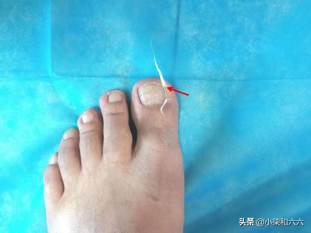 得了甲沟炎该怎么办？千万别急着拔甲