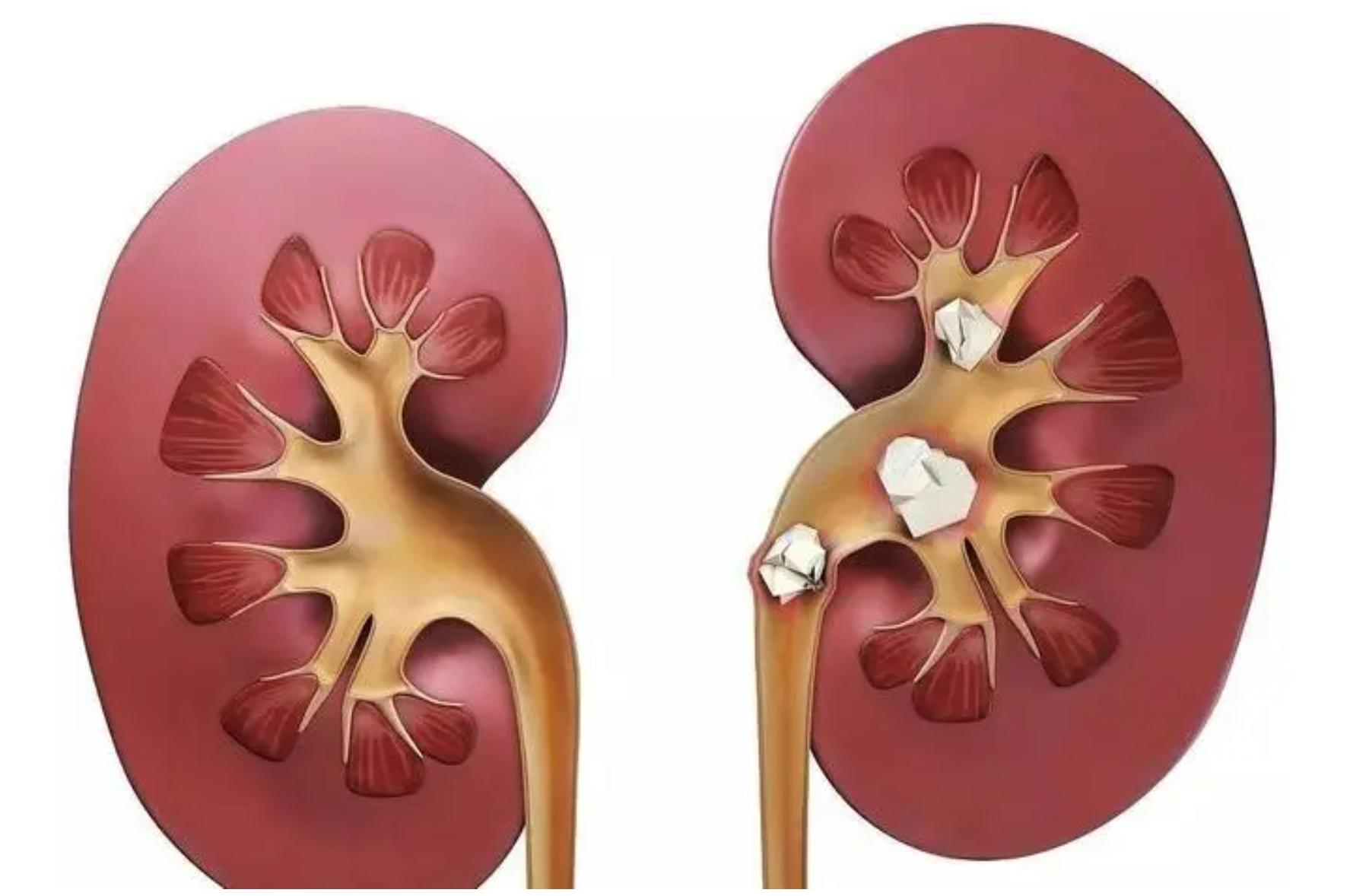 体检尿检呈阳性怎么回事,入职体检尿检有隐血怎么办