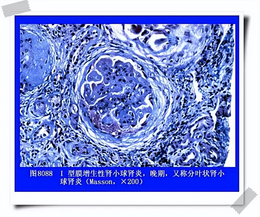 肺癌肾病综合症,32岁女性双下肢水肿