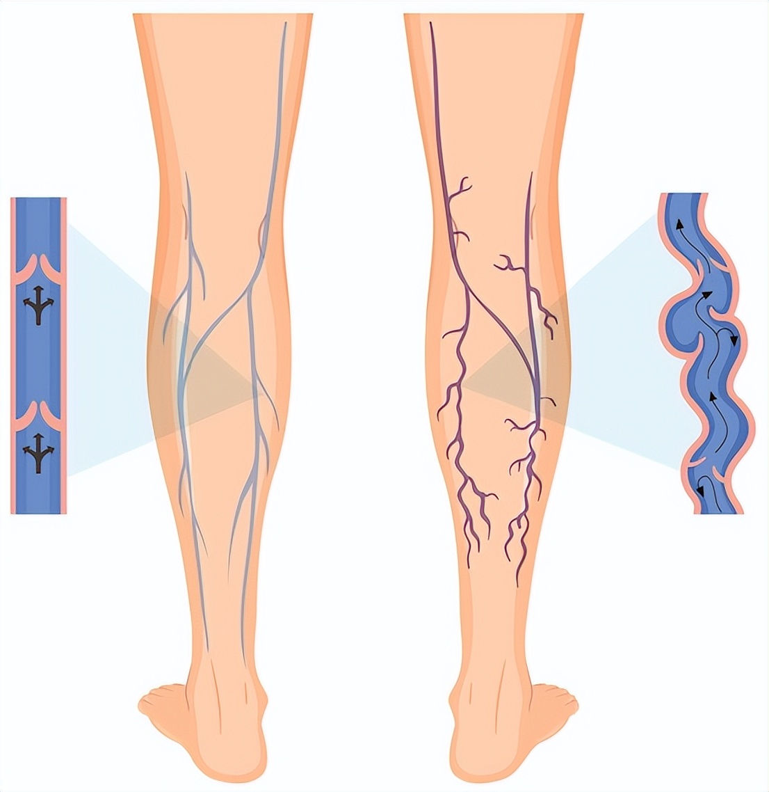 蚯蚓腿最怕什么药,如何防治蚯蚓腿