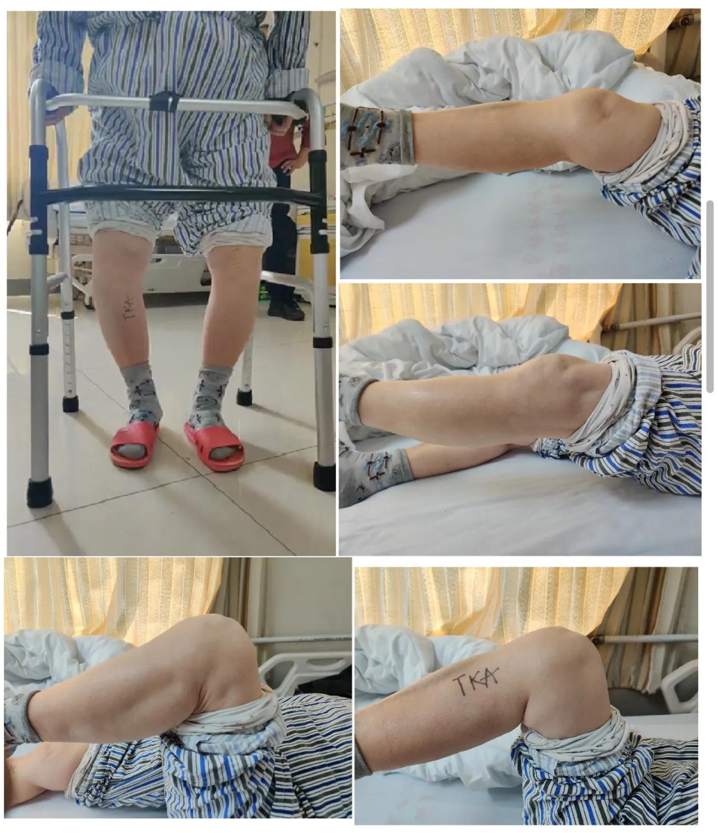 双膝重度骨性关节炎诊疗一例---匠琢骨科