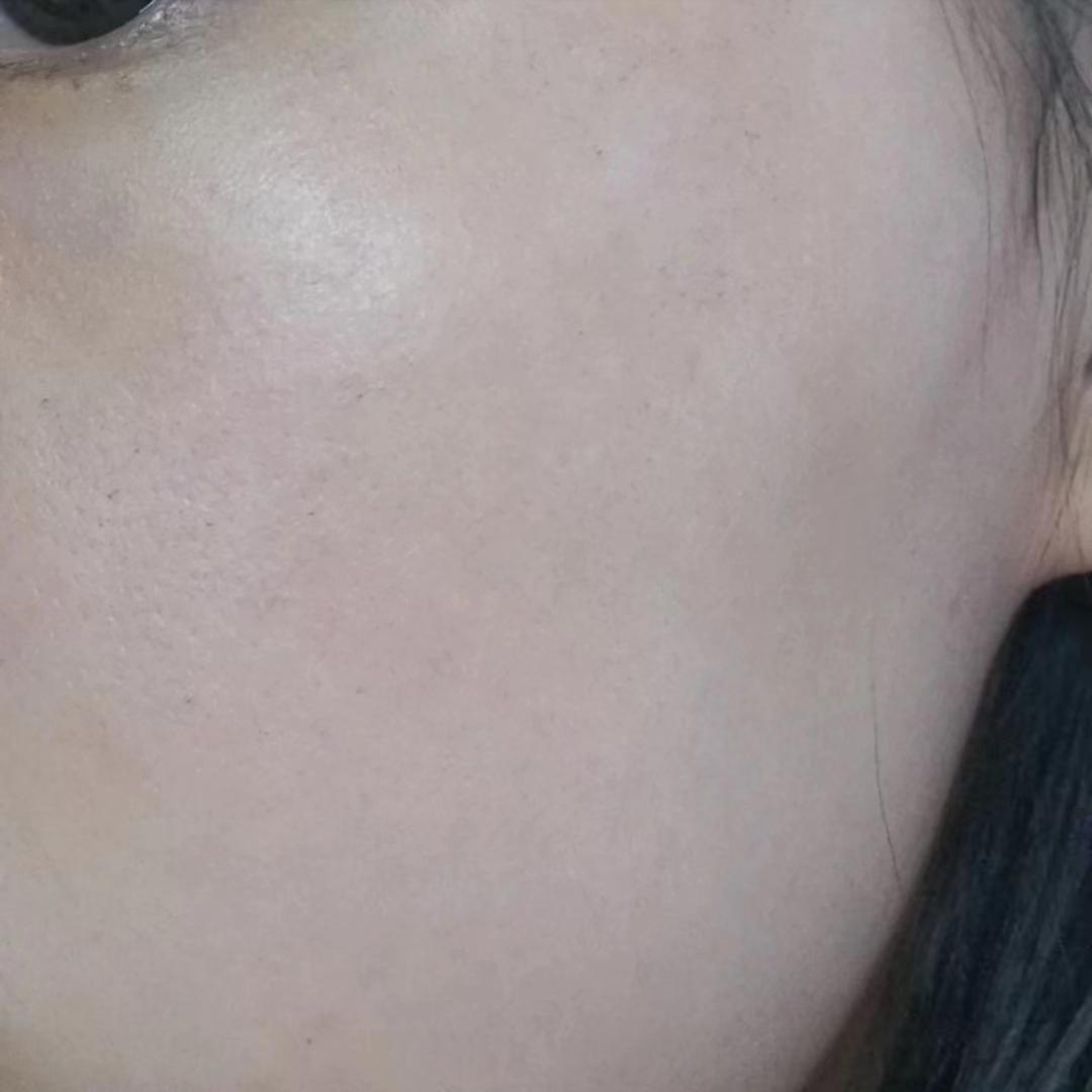 去尝试了一个医美项目光子嫩肤,光子嫩肤的亲身体验