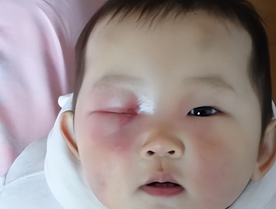 孩子眼球20分钟被熔化,小孩眼珠被熔化了怎么办