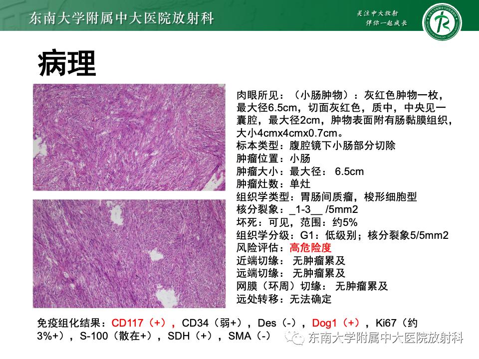 小肠间质瘤最新治疗中药方,小肠间质瘤基因检测