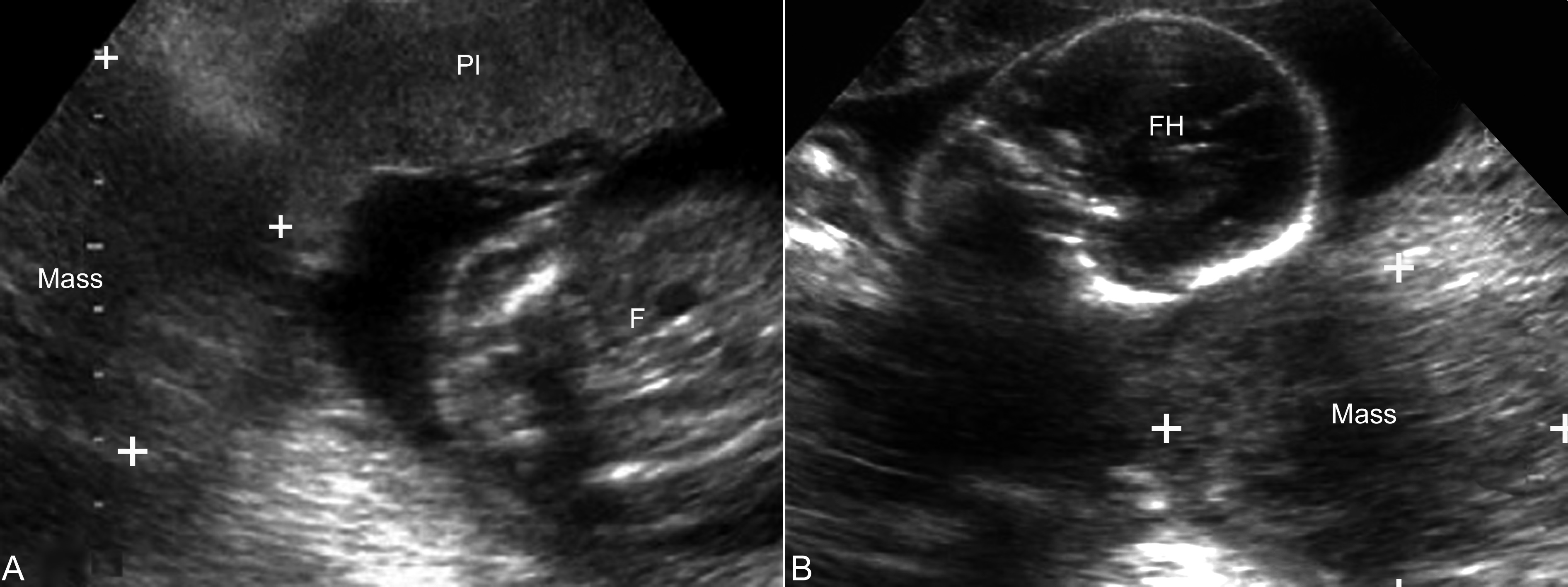 妊娠合并卵巢肿瘤指南,妊娠合并卵巢肿瘤严重吗