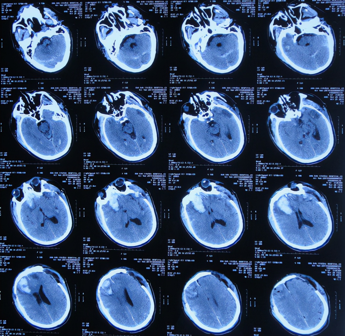 脑外伤后硬膜下积液颅骨修补,颅骨修复手术失败导致脑积水