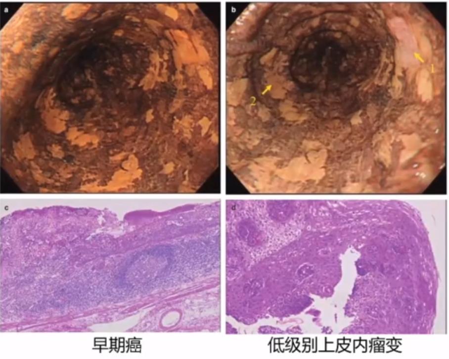 胃肠镜活检ps啥意思,胃肠镜活检主要是干什么的