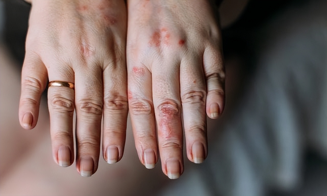 湿疹抓痒后严重,湿疹用999皮炎平更痒了怎么回事