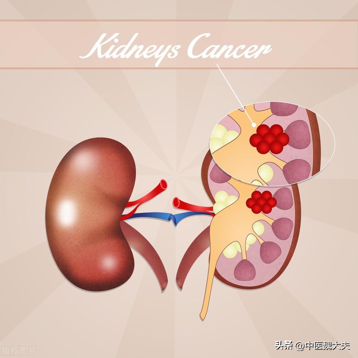 尿毒症才不是单纯的肾病,尿毒症早期的4个坏习惯