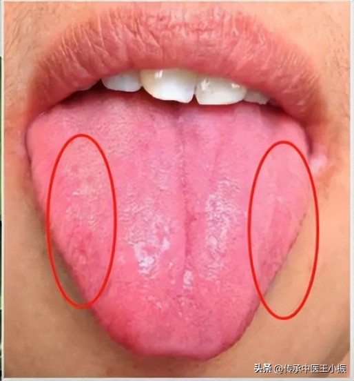 口干口苦怎么疏肝利胆化湿,晨起口苦口干别大意清肝火