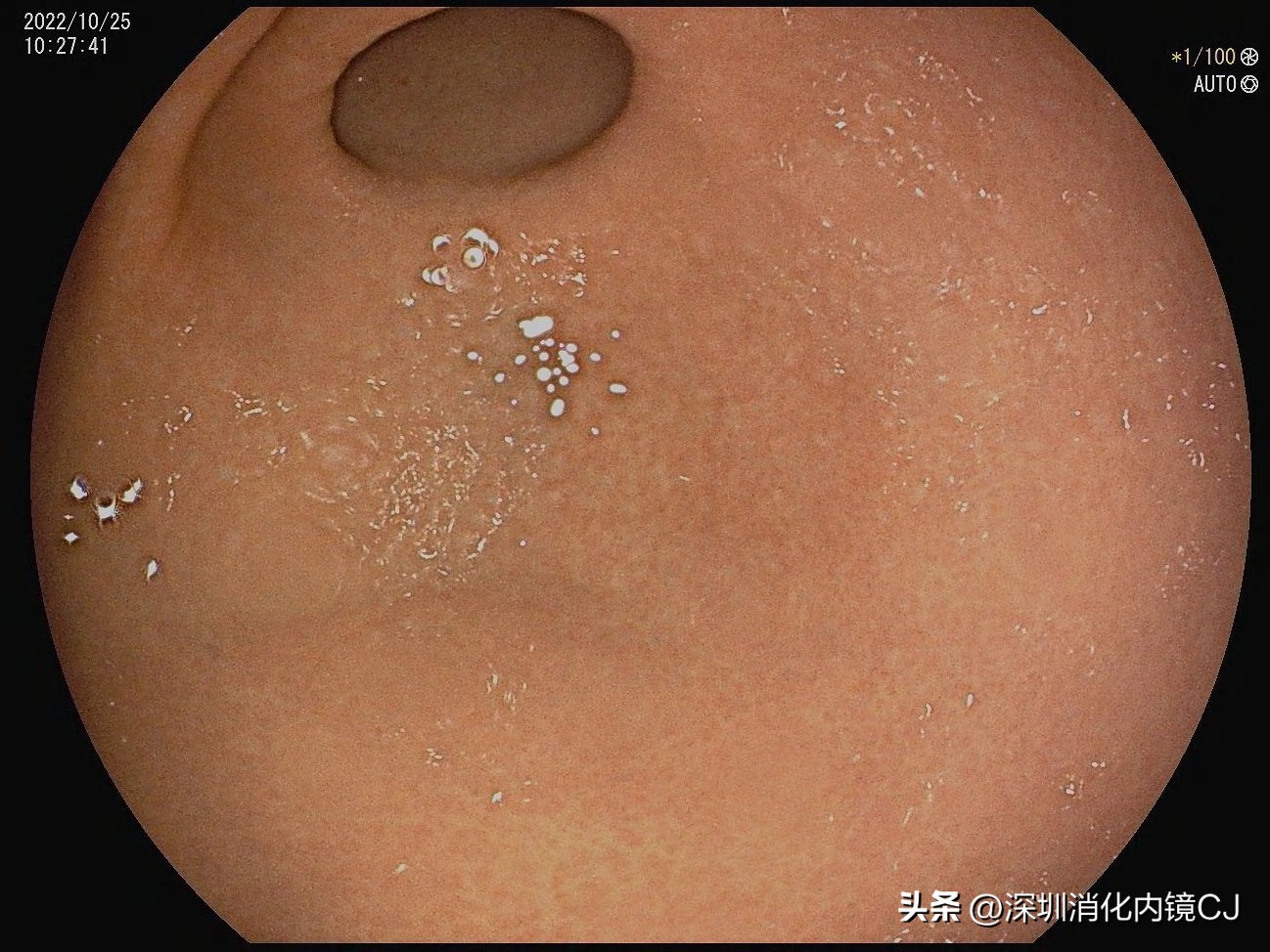 幽门螺旋杆菌感染胃粘膜表现,没有幽门杆菌但是胃窦鸡皮样改变