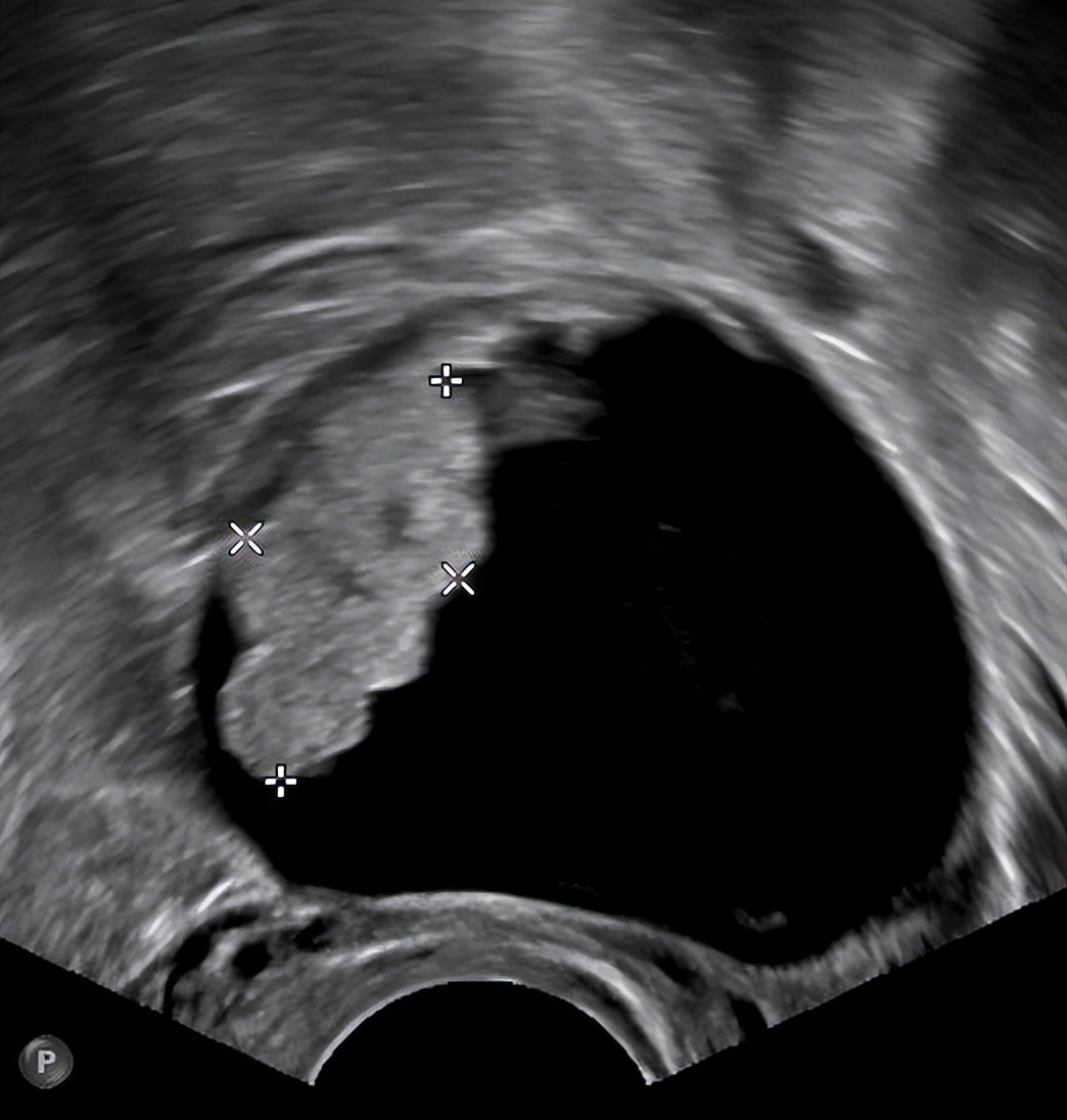 超声显示子宫肌瘤卵巢囊肿,显微镜下的卵巢囊肿