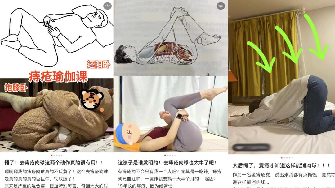 根除痔疮最好的办法，竟然是……（不是提肛