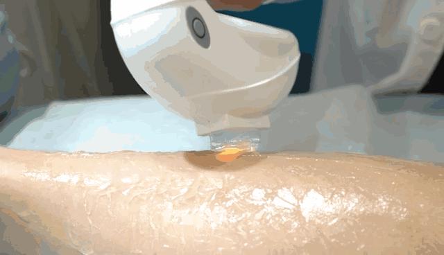 什么方法脱毛见效快又安全,女性脱毛最持久的方法