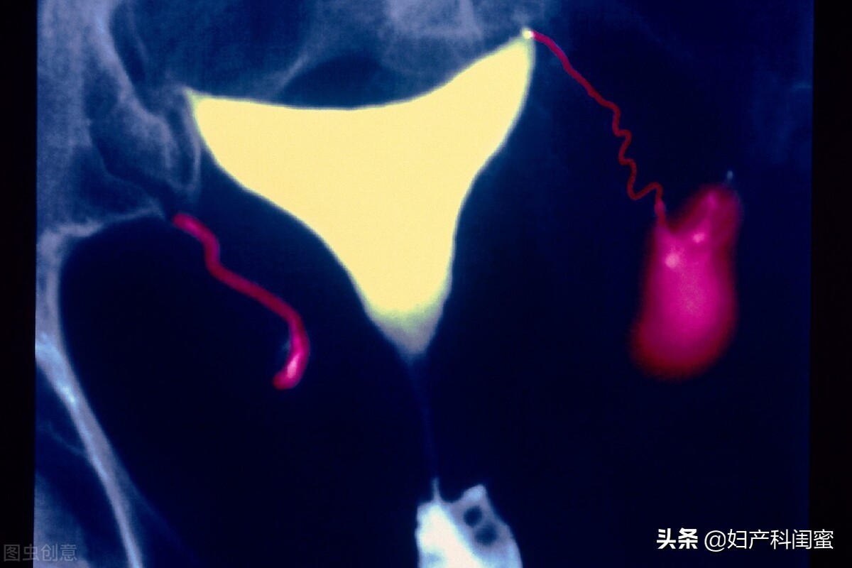 此路通不通，您痛不痛！子宫输卵管造影，最关心、担心的都在这