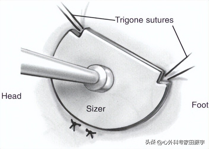 二尖瓣成形术,二尖瓣成形术后需要静养多久