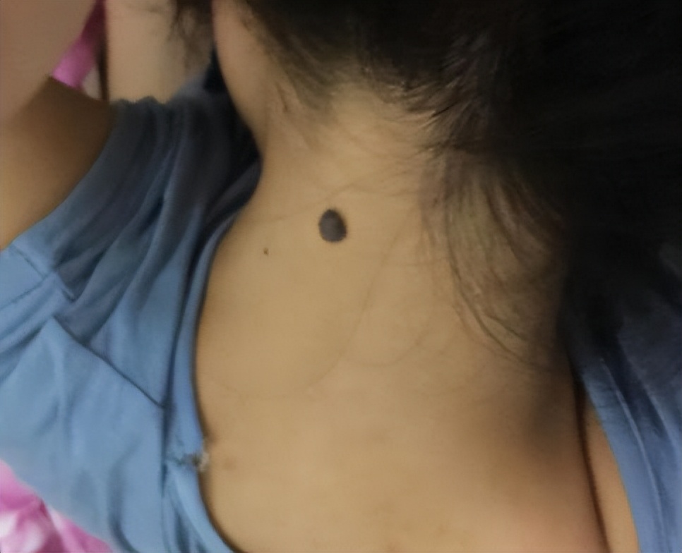 医生如何检查黑痣和黑色素瘤,医生长在摩擦部位的黑痣要当心