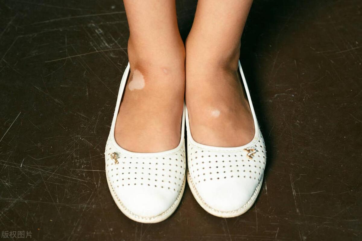 白癜风消失后，为什么患者还需要巩固治疗？