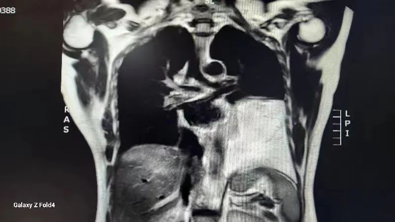 市中心医院胸外科：镜下“小切口”解决纵膈“大问题”