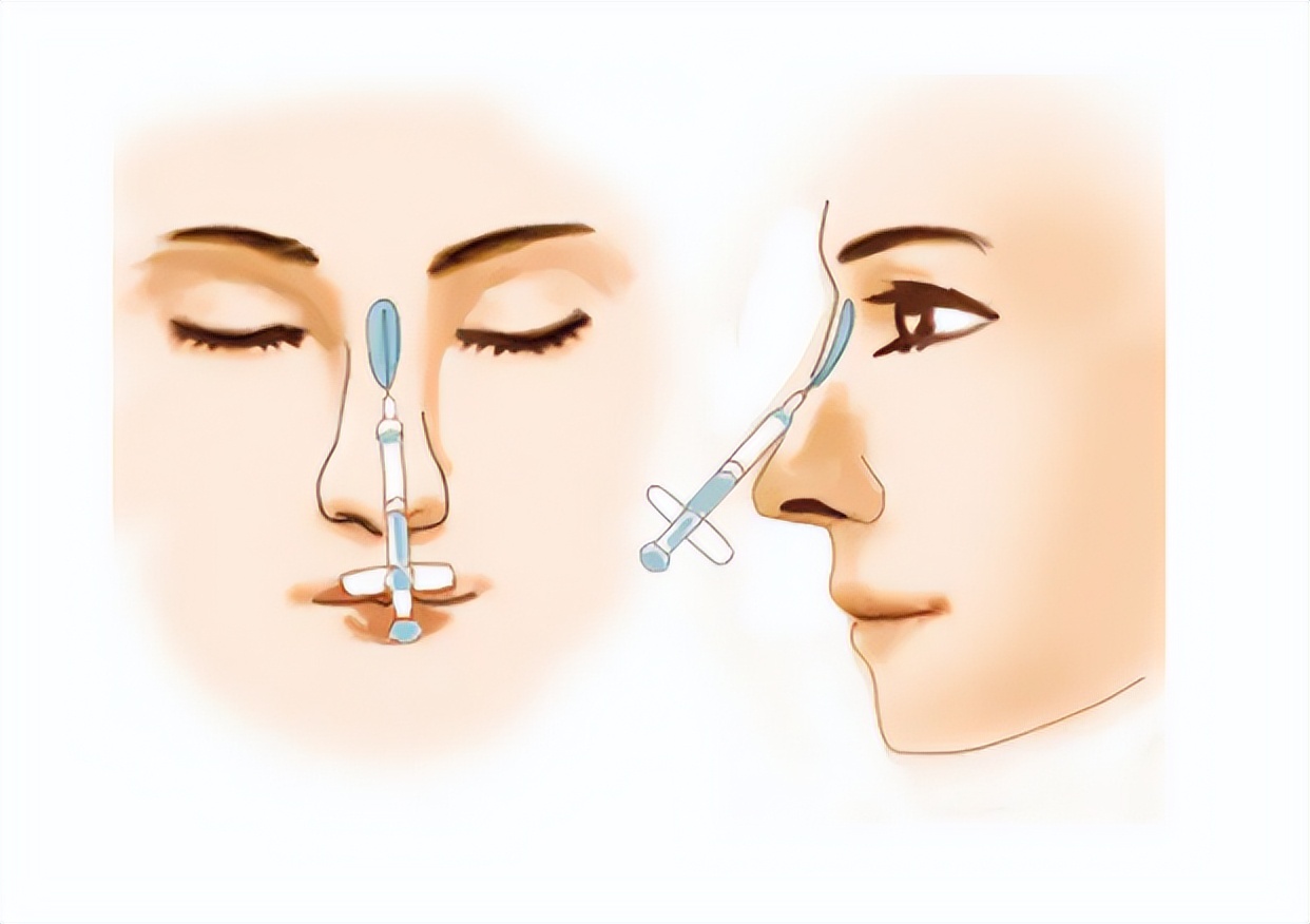 苏州韦敏隆鼻医生,九院韦敏隆鼻怎么样