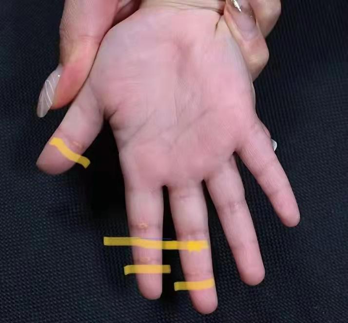 2岁孩子手上长小白点的小疙瘩,2岁宝宝手上长小疹子