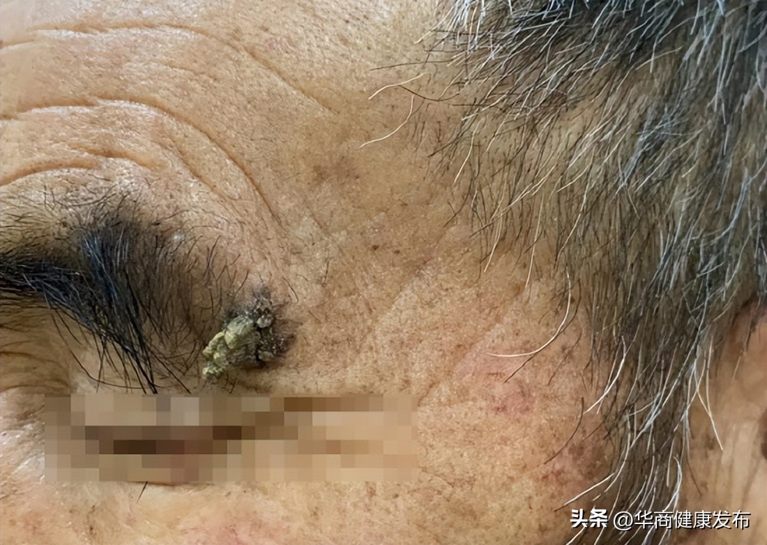 老太头上长犄角查出皮肤肿瘤,老太额头长犄角查出病