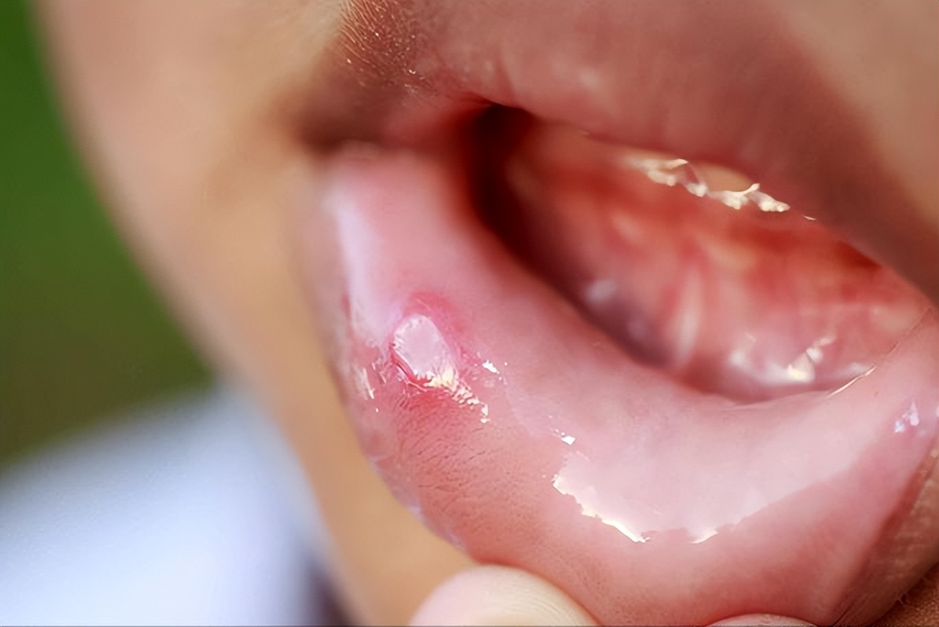 口腔溃疡含维c特别疼,口腔溃疡可以同时吃维b2和维c吗