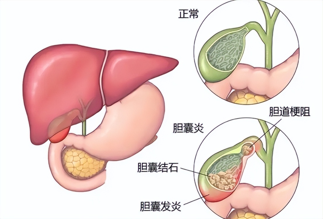 龙胆泻肝丸治疗湿热效果怎么样,龙胆泻肝丸祛湿热管用吗