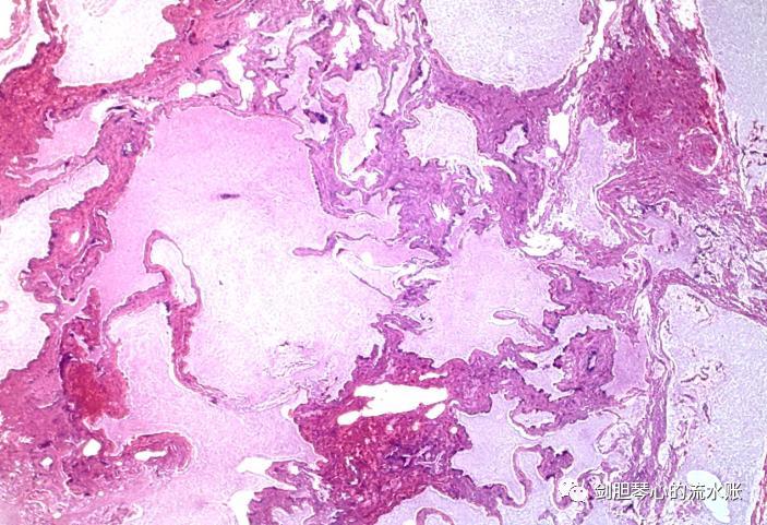 左肺下叶肺隔离症需手术吗,左肺下叶肺隔离症是什么意思