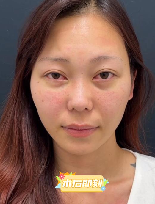 内切去眼袋手术全过程,做了去眼袋手术五天怎么还有眼袋