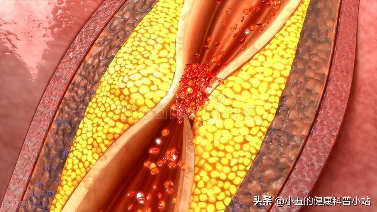 依折麦布是新型降脂药，改善低密度脂蛋白水平，服用应注意这4点