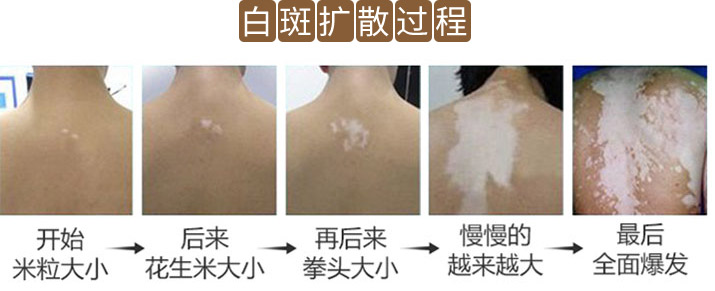 白癜风拖延治疗最终会变成什么样子？这下不敢再拖了