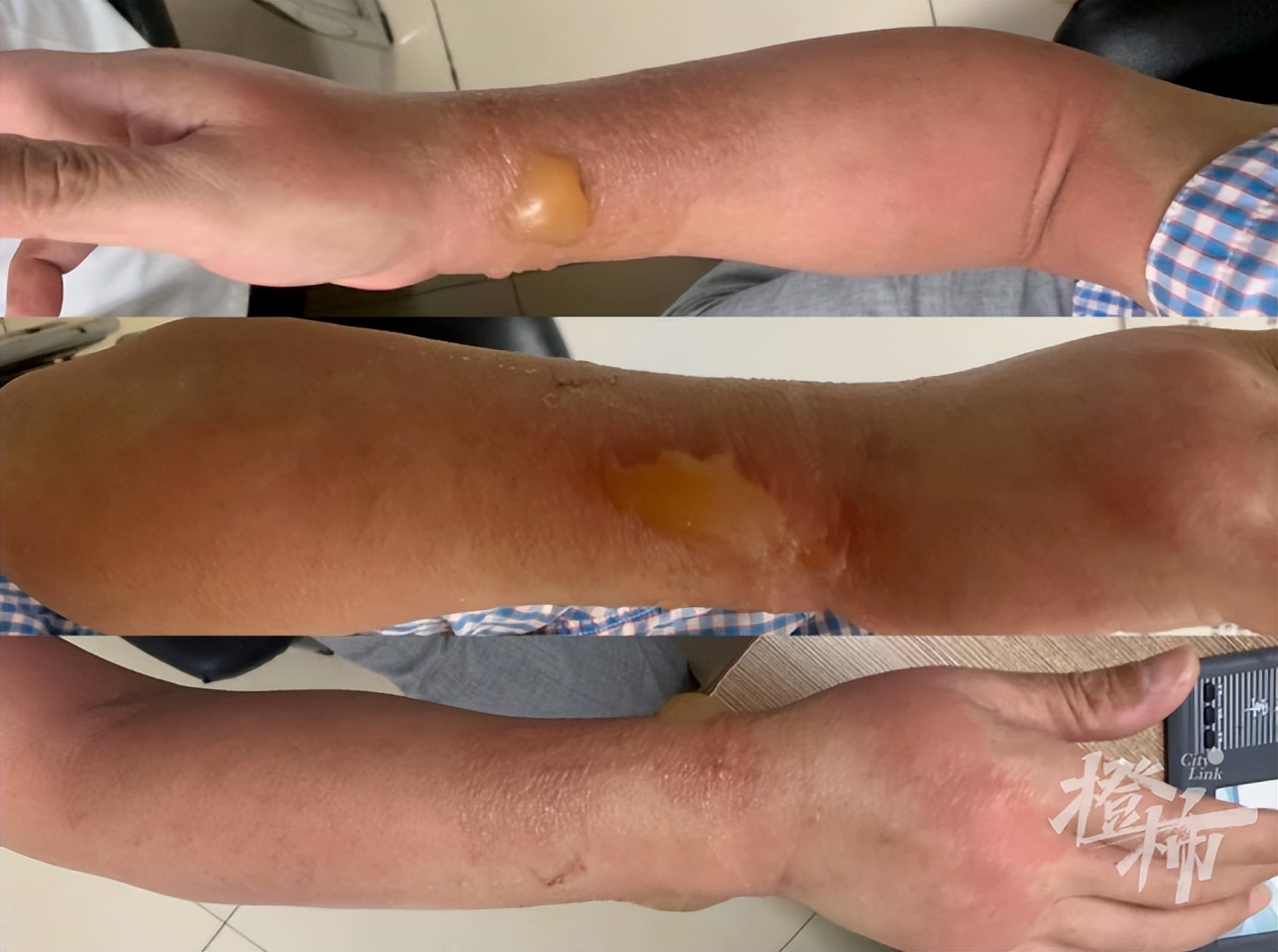 被叮了一口手上肿了个大包,被叮了一下肿了个大包